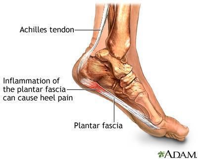 image of foot showing plantar fasciitis