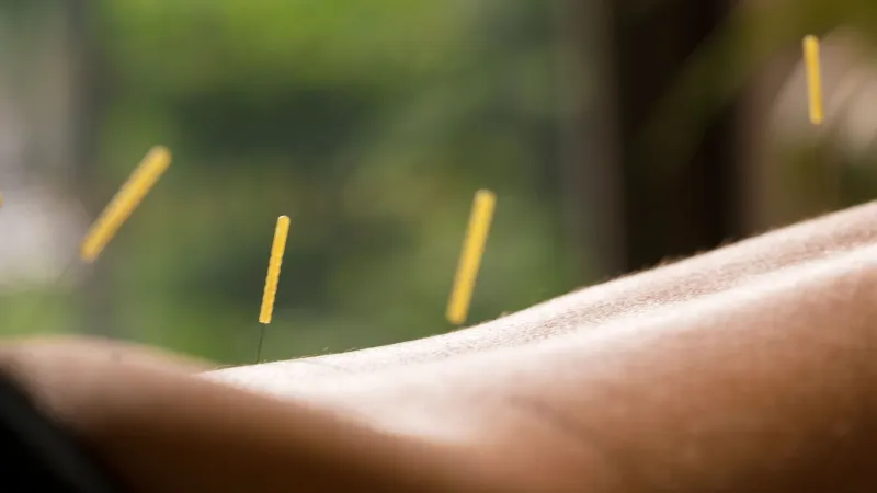 Acupuncture - An ancient therapy in modern times